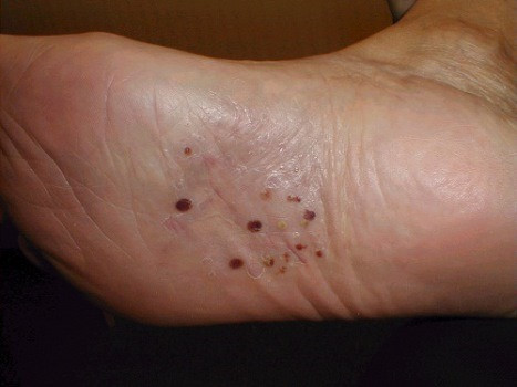 Tổ đỉa - Hình ảnh minh họa